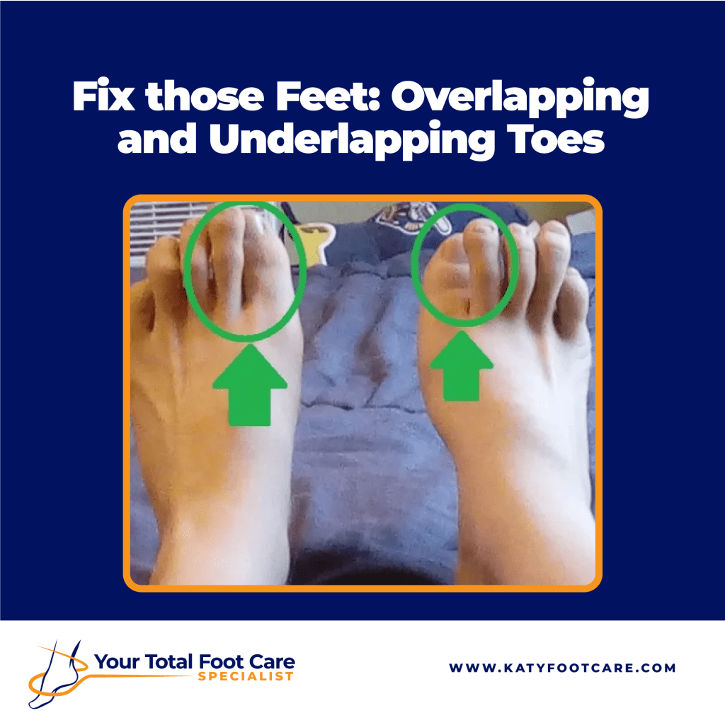 Overlapping and Underlapping Toe
